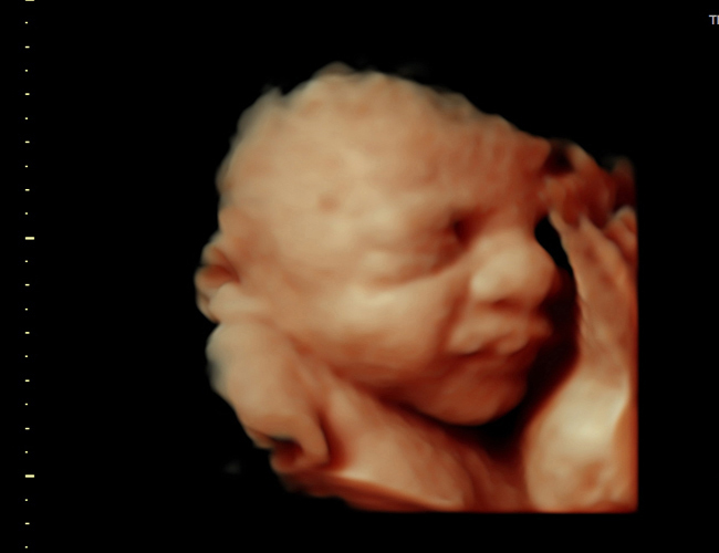 3D ultrasound image at 31 weeks